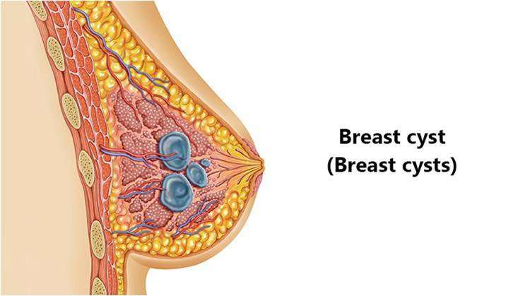 Breast Cyst: Causes, Symptoms, Treatment And Prevention ...
