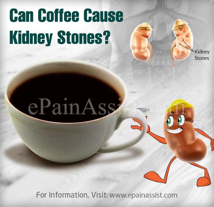 Can Coffee Cause Kidney Stones?