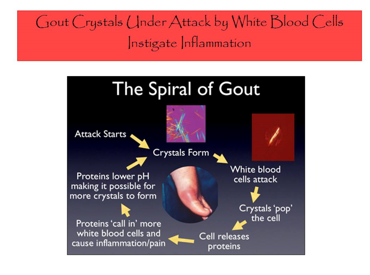 Everything You Ever Wanted to Know About Gout: Causes ...