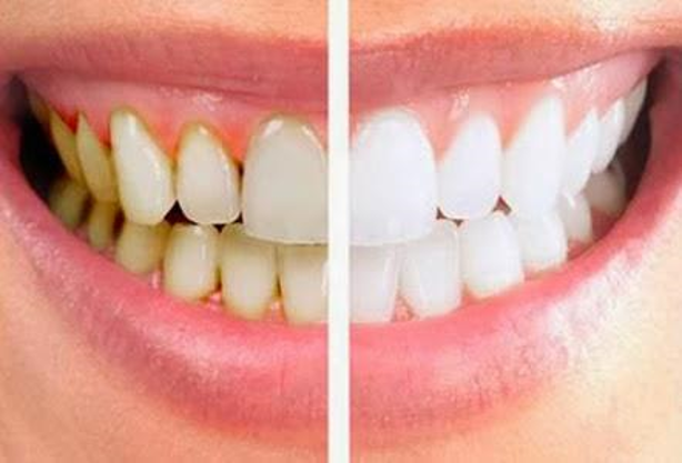 How does Coffee Stain your Teeth?