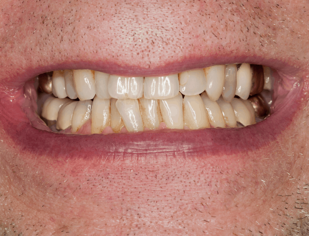 How to Remove Coffee Teeth Stains